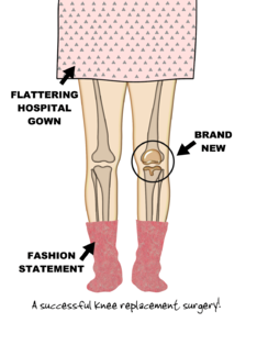 Left Knee Replacement Surgery Patient with New Knee Custom Get Well